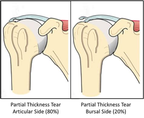 supraspinatus tear tests|incomplete full thickness tear supraspinatus.